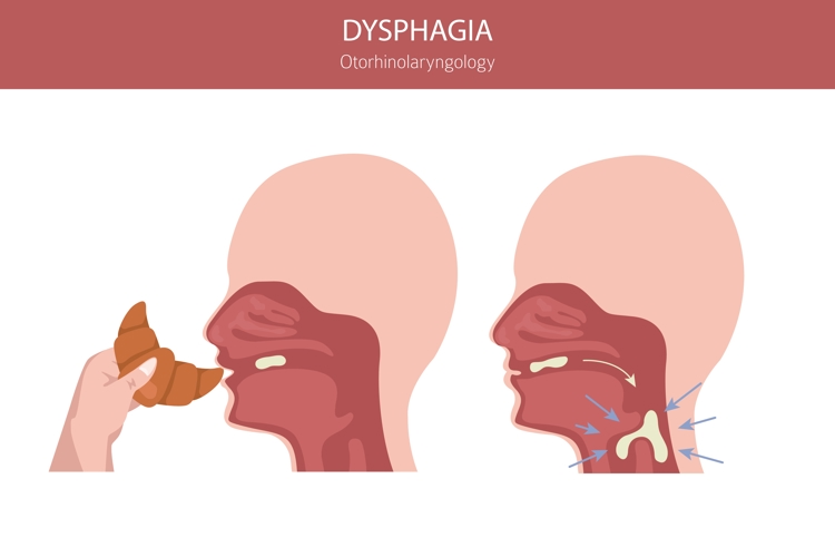 Dysfagi illustration